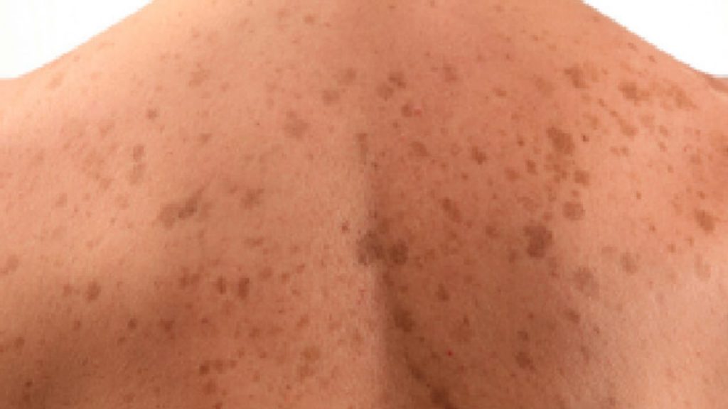 Macchie sulle pelle - (cataniaoggi.it-pexels)