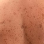 Macchie sulle pelle - (cataniaoggi.it-pexels)