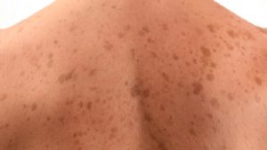 Macchie sulle pelle - (cataniaoggi.it-pexels)